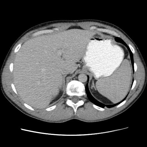 File:Appendicitis complicated by post-operative collection (Radiopaedia 35595-37114 A 19).jpg