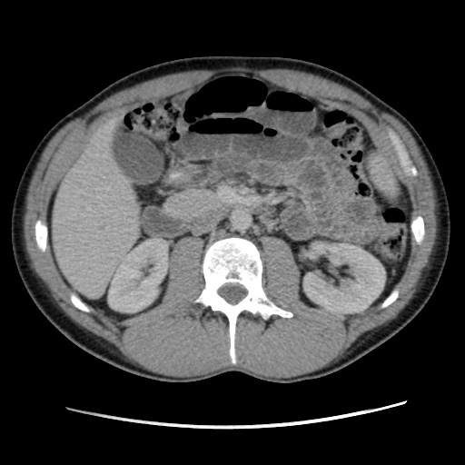 Appendicitis complicated by post-operative collection (Radiopaedia 35595-37114 A 36).jpg