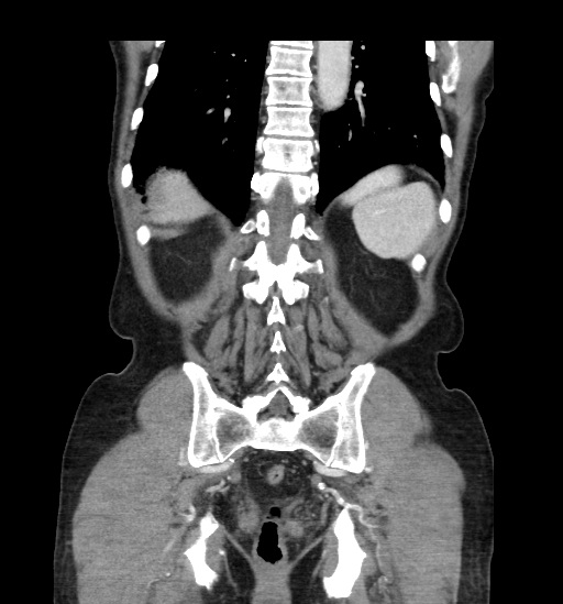 Appendicitis with localized perforation and abscess formation (Radiopaedia 49035-54130 B 39).jpg