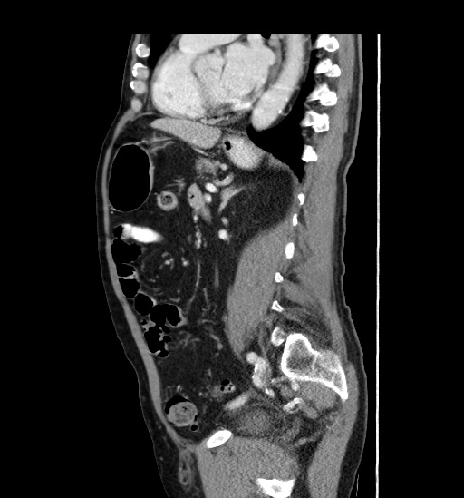Appendicitis with localized perforation and abscess formation (Radiopaedia 49035-54130 C 39).jpg