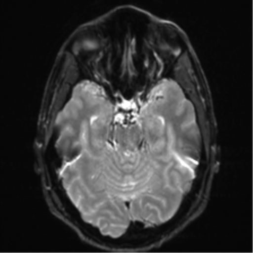 Arachnoid cyst - cerebellopontine angle (Radiopaedia 59689-67083 Axial DWI 13).png