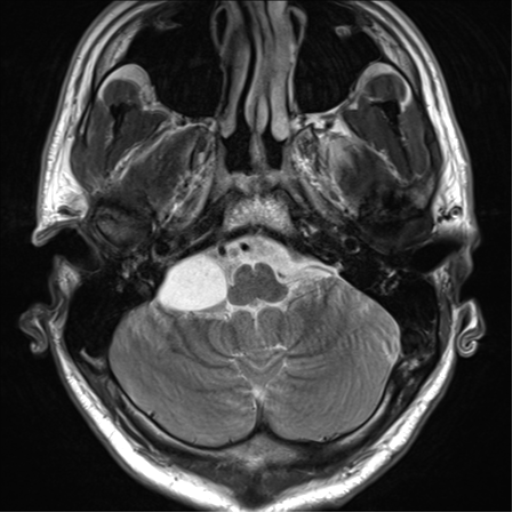 File:Arachnoid cyst - cerebellopontine angle (Radiopaedia 59689-67083 Axial T2 11).png