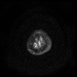 Arachnoid cyst - middle cranial fossa (Radiopaedia 86780-102938 Axial DWI 30).jpg