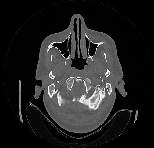 Arcuate foramen (Radiopaedia 89833-106944 Axial bone window 5).jpg