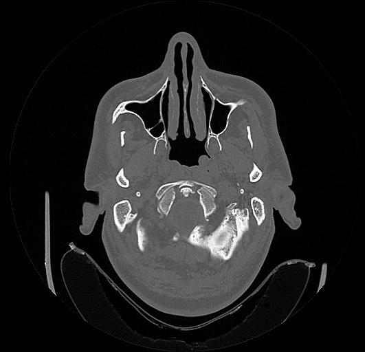 Arcuate foramen (Radiopaedia 89833-106944 Axial bone window 6).jpg