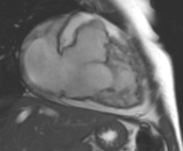 Arrhythmogenic right ventricular cardiomyopathy (Radiopaedia 69431-79307 2ch cine 52).jpg