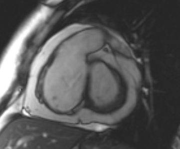 Arrhythmogenic right ventricular cardiomyopathy (Radiopaedia 69431-79307 Short axis cine 172).jpg