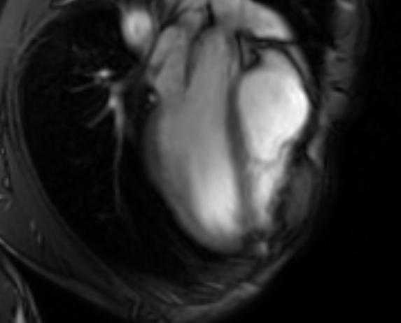 Arrhythmogenic right ventricular cardiomyopathy (Radiopaedia 69564-79464 4ch cine 23).jpg