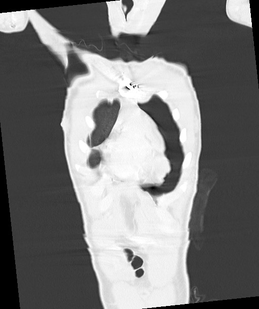 Arrow injury to the chest (Radiopaedia 85367-100975 Coronal lung window 43).jpg