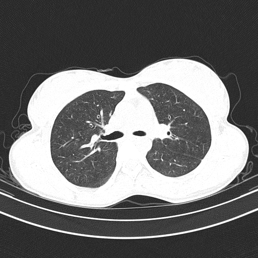 Arteria lusoria (Radiopaedia 88528-105192 Axial lung window 26).jpg