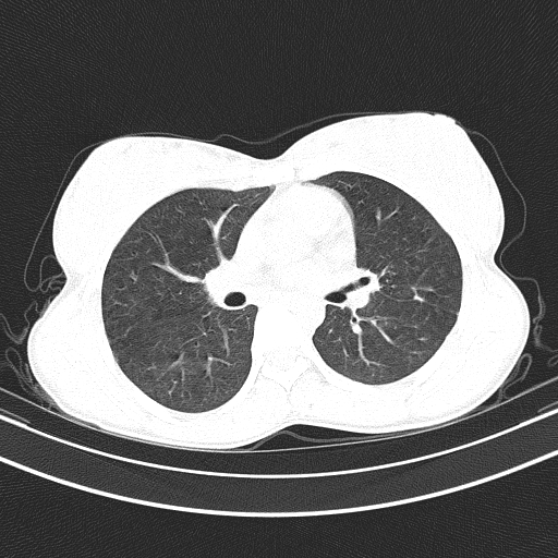 Arteria lusoria (Radiopaedia 88528-105192 Axial lung window 31).jpg