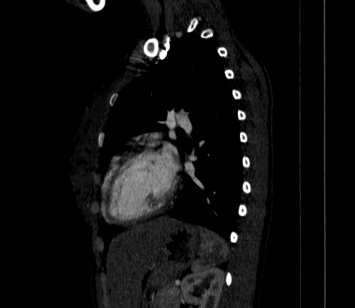 File:Arteria lusoria (Radiopaedia 88528-105192 C 62).jpg