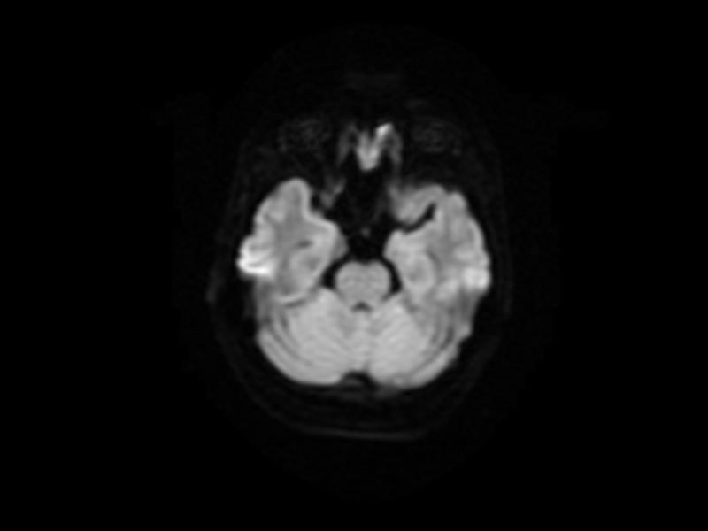File:Artery of Percheron infarct (Radiopaedia 36897-38526 Axial DWI 6).jpg