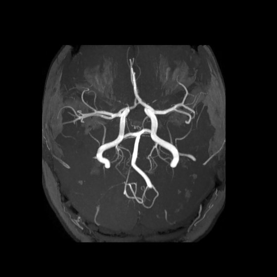 Artery of Percheron infarct (Radiopaedia 40966-43676 F 19).jpg