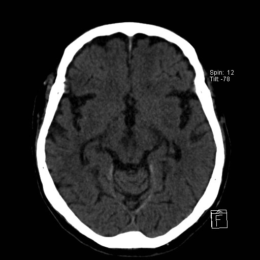 File:Artery of Percheron infarction (Radiopaedia 26307-26439 Axial non-contrast 5).jpg