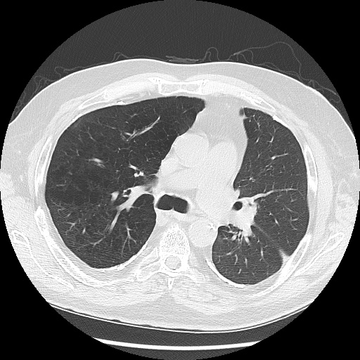 Asbestos-related pleural disease (Radiopaedia 74366-85250 Axial lung window 50).jpg