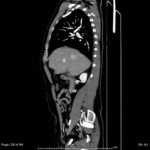 Ascending aortic aneurysm (Radiopaedia 50086-55404 C 20).jpg