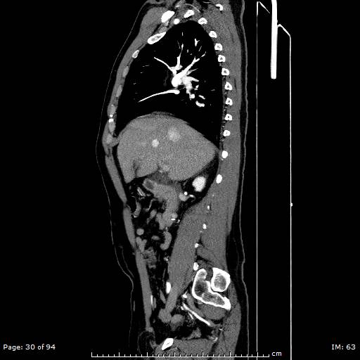 File:Ascending aortic aneurysm (Radiopaedia 50086-55404 C 22).jpg