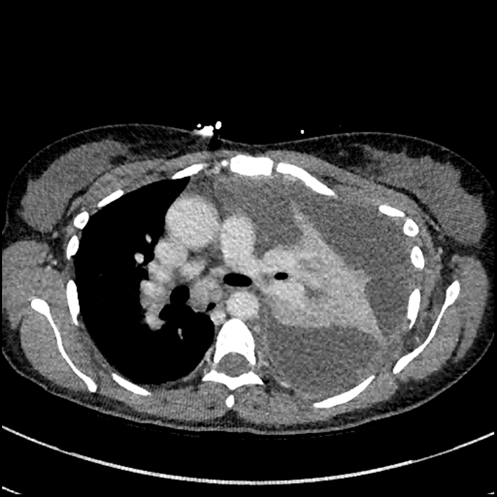Aspiration pneumonia complicated by empyema (Radiopaedia 73024-83767 B 139).jpg