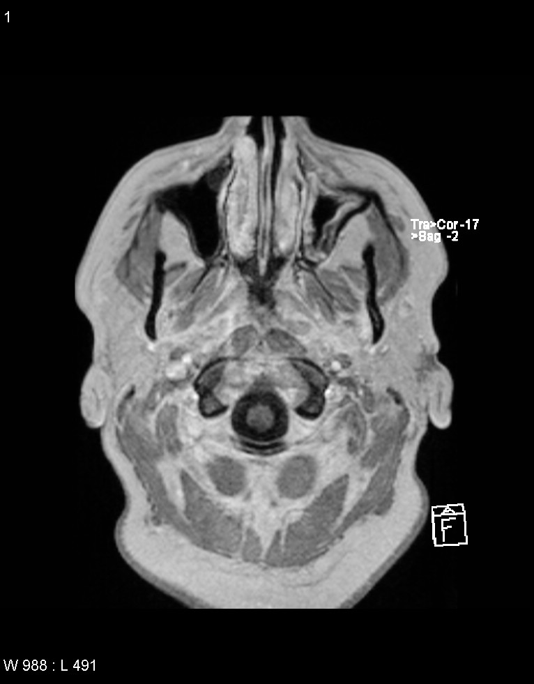 Astroblastoma (Radiopaedia 39792-42217 Axial T1 C+ 59).jpg