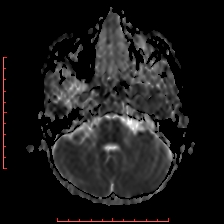 Astroblastoma (Radiopaedia 74287-85162 Axial ADC 11).jpg