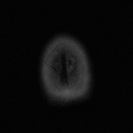 File:Astrocytoma - WHO grade II (Radiopaedia 16279-15959 Axial T2 1).jpg