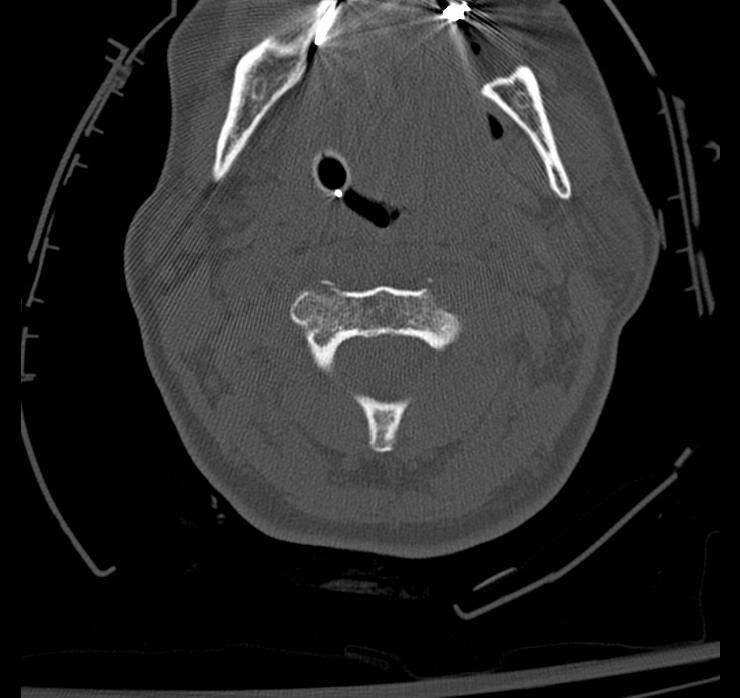 Atlanto-axial subluxation-dislocation (Radiopaedia 29659-30185 Axial bone window 39).jpg