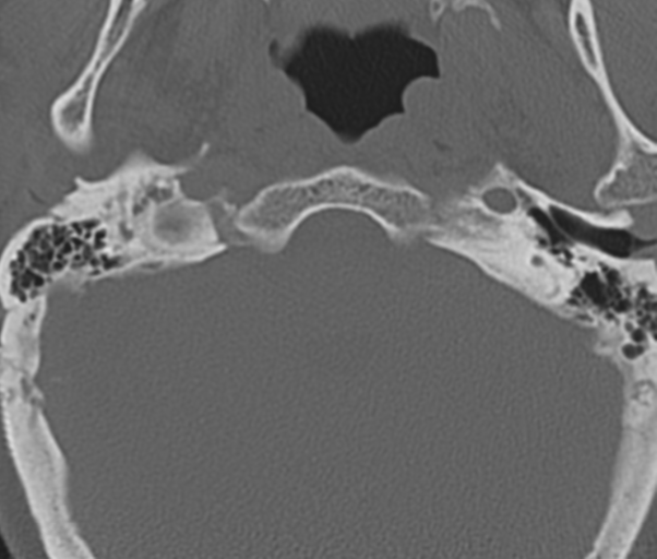 Atlanto-axial subluxation (Radiopaedia 36610-38176 Axial bone window 5).png