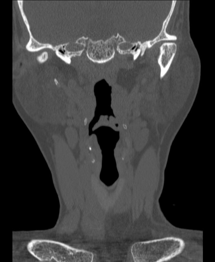 Atlanto-occipital assimilation with basilar invagination (Radiopaedia 70122-80188 Coronal bone window 14).jpg