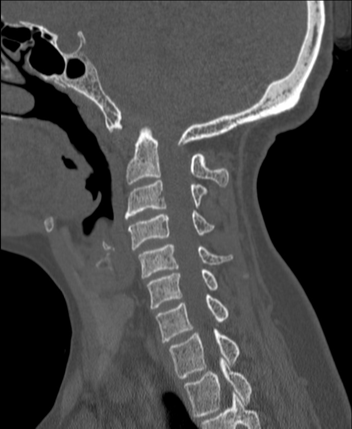 Atlanto-occipital assimilation with basilar invagination (Radiopaedia 70122-80188 Sagittal bone window 47).jpg