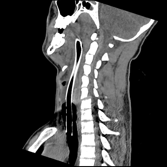 File:Atlanto-occipital dissociation (Traynelis type 1), C2 teardrop fracture, C6-7 facet joint dislocation (Radiopaedia 87655-104061 D 43).jpg