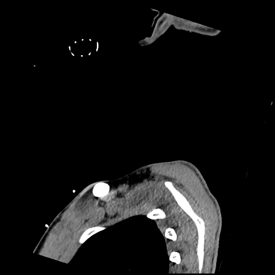 Atlanto-occipital dissociation (Traynelis type 1), C2 teardrop fracture, C6-7 facet joint dislocation (Radiopaedia 87655-104061 D 84).jpg