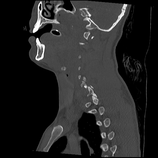 File:Atlanto-occipital dissociation (Traynelis type 1), C2 teardrop fracture, C6-7 facet joint dislocation (Radiopaedia 87655-104061 Sagittal bone window 24).jpg