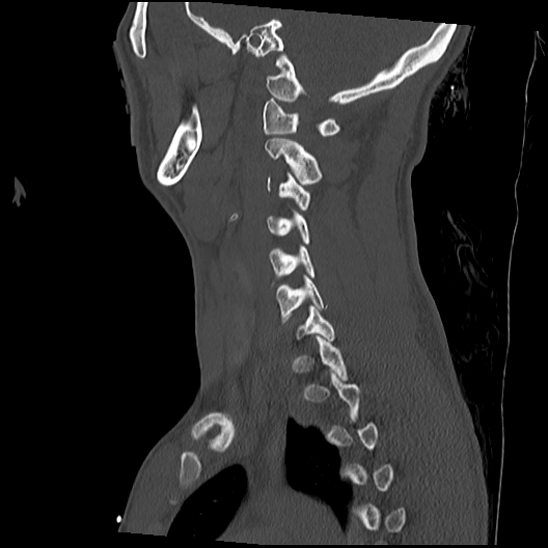 Atlanto-occipital dissociation (Traynelis type 1), C2 teardrop fracture, C6-7 facet joint dislocation (Radiopaedia 87655-104061 Sagittal bone window 45).jpg