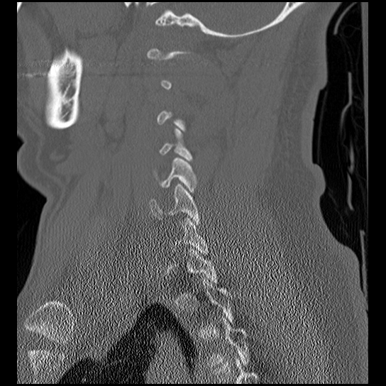 Atlanto-occipital dissociation injury (Radiopaedia 29274-29698 Sagittal bone window 42).png
