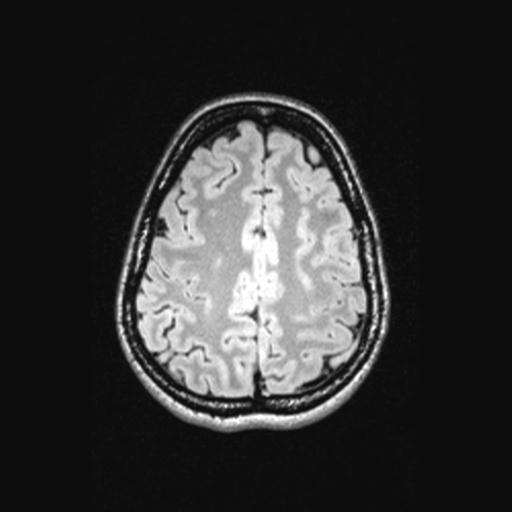 Atretic encephalocoele with inferior vermis hypoplasia (Radiopaedia 30443-31108 Axial 120).jpg