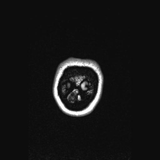Atretic encephalocoele with inferior vermis hypoplasia (Radiopaedia 30443-31108 Coronal FLAIR 12).jpg