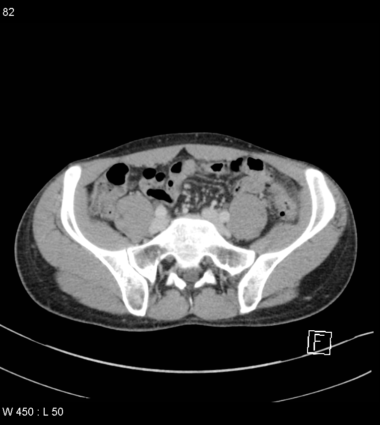 Atypical acute epiploic appendagitis (Radiopaedia 55479-61943 A 81).jpg