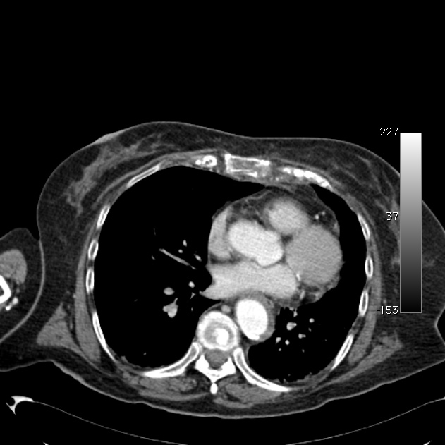 Atypical dissection of the thoracic aorta (Radiopaedia 10975-11393 A 45).jpg
