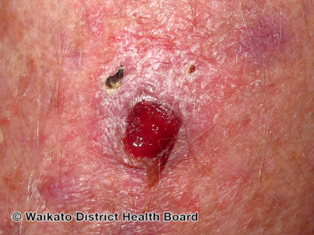 File:Atypical fibroxanthoma (DermNet NZ lesions-w-atypical-fibroxanthoma).jpg