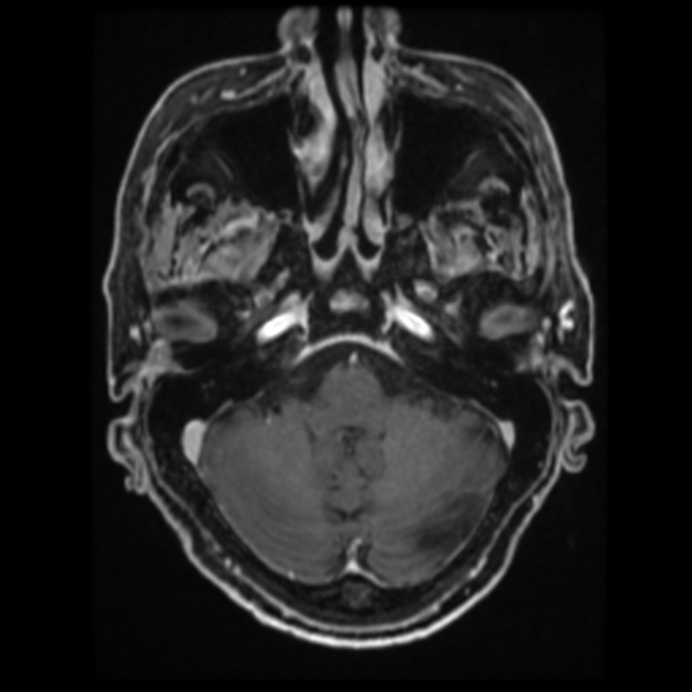 Atypical meningioma (Radiopaedia 45535-49629 Axial T1 C+ 23).jpg