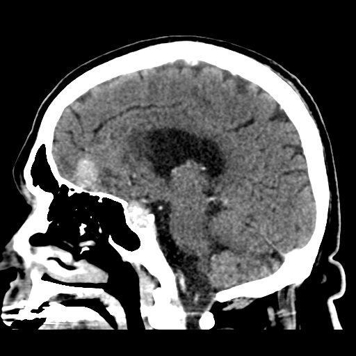 Atypical meningioma (WHO grade II) with brain invasion (Radiopaedia 57767-64728 Sagittal C+ 29).png