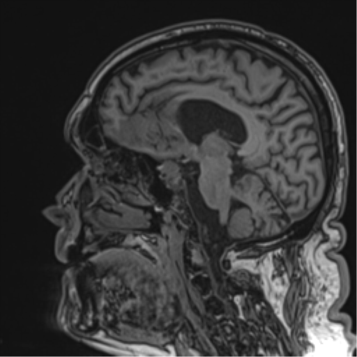 Atypical meningioma (WHO grade II) with brain invasion (Radiopaedia 57767-64729 Sagittal T1 33).png