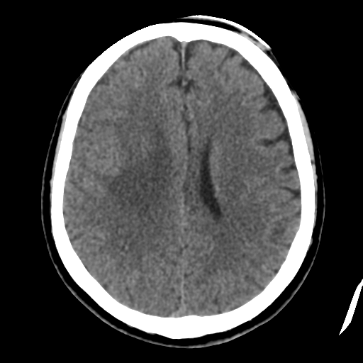 Atypical meningioma (WHO grade II) with osseous invasion (Radiopaedia 53654-59715 Axial non-contrast 34).png