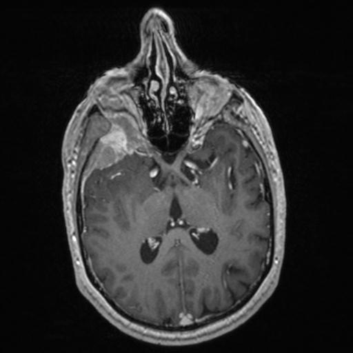 Atypical meningioma (grade II) - en plaque (Radiopaedia 29633-30147 Axial T1 C+ 91).jpg