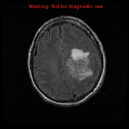 File:Atypical meningioma - grade II (Radiopaedia 13303-13305 Axial FLAIR 16).jpg