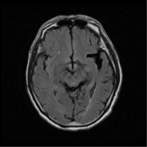 File:Atypical meningioma with skull invasion (Radiopaedia 34357-35648 Axial FLAIR 10).png