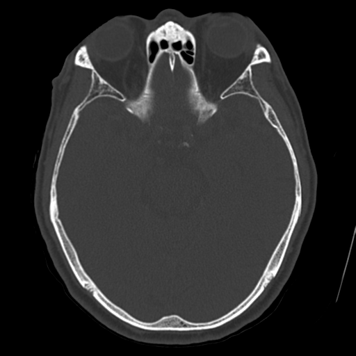 Atypical meningioma with skull invasion (Radiopaedia 34357-35649 Axial bone window 33).png