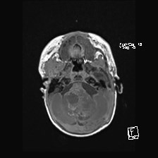 Atypical teratoid rhabdoid tumor (prenatal US and neonatal MRI) (Radiopaedia 59091-66388 Axial T1 15).jpg