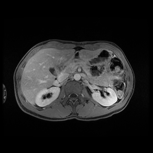 Autoimmune pancreatitis (Radiopaedia 69751-79729 Axial T1 C+ fat sat 62).jpg